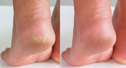 Image before and after treatment of dry heels cracks skin dehydrated skin on heels of female feet.