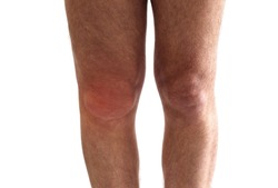 Knee effusion, fluid or water round the knee joint. Adult man with knee swollen the swelling and redness of the skin because of fluid build up inside. 