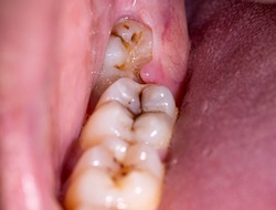 Impacted wisdom tooth due to which a gum hood was formed. Inflammation of the gums due to an unerupted molar, macro