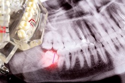 Impacted wisdom teeth on an X-ray picture with an inflamed cyst neoplasm. Removal of wisdom teeth in dentistry