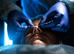 Doctor plastic surgeon conducts an operation of a female patient to reduce the shape of the nose, rhinoplasty. Close-up, anatomical