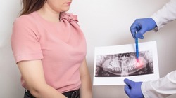 The doctor holds a panoramic X-ray picture of the patient's teeth with a sick semi-urethinal wisdom tooth. Wisdom teeth extraction concept in dentistry, dental abscess