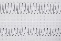 Sustained monomorphic ventricular tachycardia on the Hilter ECG 