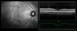 Ophthalmic test - OCT optical coherence tomography measurement. SLO Scan view of the macula in retina with vessels