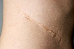 surgery scar after kidney pyelonephritis. after remove kidney operation. caucasian person close up over gray background.