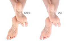 Feet with dry skin before and after treatment. foot cream, moisturizer. Dry and cracked soles of feet. female legs in an elegant position. sore skin of feet, dry heels