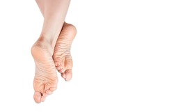 rough skin on soles of feet. dry heels, dry chapped skin on feet requiring care isolated on white background, dry skin on heels and soles needs care. copy space