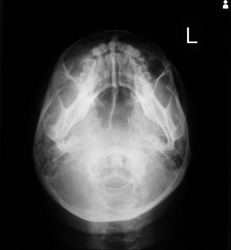 Submentovertex Skull X-ray