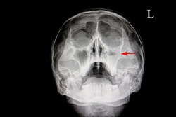 xray film of a skull of a patient (paranasal sinus) with acute right maxillary sinusitis (red arrow) with air fluid level