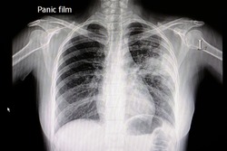 A chest x ray film of a patient with left middle lung pneumonia.  Medical Education. Abnormal xray in lung infections. Covid 19 pneumonia.