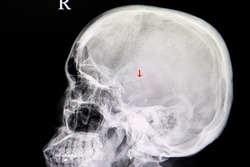 A skull xray film of a traumatic brain injury patient showing a temporoparietal linear fracture of the skull. Skull fracture. Traumatic accidental film. Education, training film.
