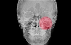 Xray film of a skull of a patient (paranasal sinus) with acute left maxillary sinusitis (red circular shade) with haziness of the left maxillary air cells.