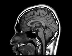 Magnetic resonance imaging or MRI scan of normal human brain, head in sagittal view, showing corpus callosum, midbrain, pons, medulla, cerebrum and cerebellum. Medical film.