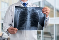 Doctor diagnosing patientâ€™s health on asthma, lung disease, COVID-19 or bone cancer illness with radiological chest x-ray film for medical healthcare hospital service