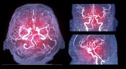 Collection of MRA brain or Magnetic resonance angiography image ( MRA ) of cerebral artery in the brain for detect stroke disease.