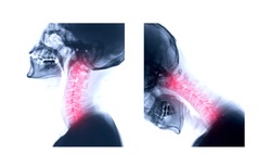 X-ray C-spine or x-ray image of Cervical spine Lateral extension and Flexion view for diagnostic intervertebral disc herniation.