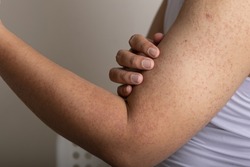 Keratosis Pilaris a harmless skin condition that causes dry, rough patches and tiny bumps, often on the upper arms