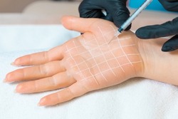 Professional cosmetology. Doctor makes injections of botulinum toxin on the female palm against hyperhidrosis. Hand with white drawn grid. Close up.