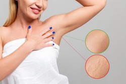 Young beautiful smiling woman showing the smooth skin of her armpits. Enlarged area with results before and after depilation procedures. The concept of photoepilation and laser hair removal