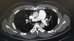 CT pulmonary artery. Acute bilateral pulmonary embolism.