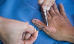 Hand with blade and forcep stitches off wound. wound closure is performed with sutures (stitches), staples. - Image