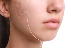 Teenage girl before and after acne treatment on white background, closeup