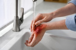 Woman holding hand with burn under flowing water indoors, closeup