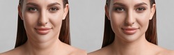 Double chin problem. Collage with photos of young woman before and after plastic surgery procedure on light grey background, banner design