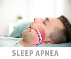 Illustration showing airway during obstructive sleep apnea