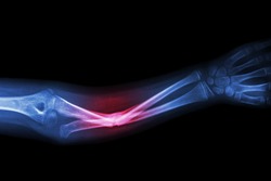 X-ray fracture ulnar bone (forearm bone)
