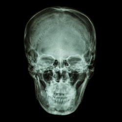 X-ray normal asian skull (Thai people)