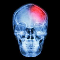 Film X-ray skull and headache. (Stroke,Cerebrovascular accident)