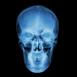 X-ray skull and Stroke ( cerebrovascular accident (CVA) )