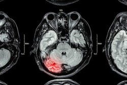MRI of brain : brain injury