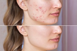 Cropped shot of a young woman's face before and after acne  treatment on face. Pimples, red scars on the cheeks and chin of the girl. Problem skin, care and beauty concept. Dermatology, cosmetology