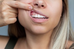Gum health. Close-up of a young woman showing healthy gums. Dentistry, dental care