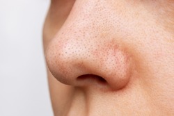 Close-up of a woman's nose with blackheads or black dots isolated on a white background. Acne problem, comedones. Enlarged pores on the face. Cosmetology dermatology concept