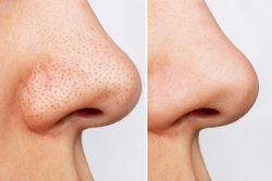 Close-up of woman's nose with blackheads or black dots before and after peeling and cleansing the face isolated on a white background. Acne problem, comedones. Difference after the cosmetic procedure