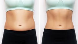 Two shots of a woman's belly with excess fat and toned slim stomach with abs before and after losing weight isolated on a white background. Result of diet, liposuction, training. Healthy lifestyle