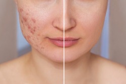 Cropped shot of a young woman's face before and after acne treatment on the face. Pimples, red scars on the cheeks of the girl. Problem skin, care and beauty concept. Dermatology, cosmetology