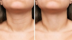 Сlose-up of young woman's neck with wrinkles before and after treatment. Result of cosmetic rejuvenating procedures. Lines, age-related changes, Venus rings. Neck lift, collagen injections, skin care