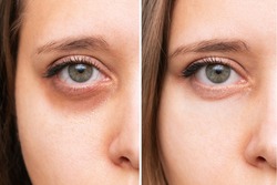 Cropped shot of a young caucasian woman's face with dark circles under eyes before and after cosmetic treatment. Bruises under the eyes caused by fatigue, insomnia. The result of therapy
