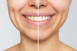 Cropped shot of a young smiling woman before and after teeth whitening isolated on a gray background. Dark tooth enamel, contrast. Dentistry, dental care