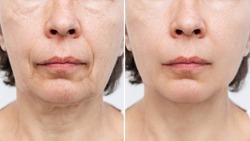 Lower part of face and neck of elderly woman with signs of skin aging before after facelift, plastic surgery on white background. Age-related changes, flabby sagging skin, wrinkles, creases, puffiness