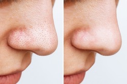Close-up of woman's nose with blackheads or black dots before and after peeling and cleansing the skin of face isolated on a white background. Acne problem, comedones. Cosmetology dermatology concept