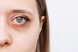 Cropped shot of a young caucasian woman's face with dark circle under eye isolated on a white background. Pale skin, bruises under the eyes are caused by fatigue, lack of sleep, insomnia and stress