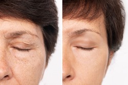 Elderly caucasian woman's face with puffiness under her eyes and wrinkles on eyelids before and after blepharoplasty. Age-related skin changes,fatigue. Result of plastic surgery. Rejuvenation