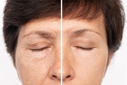 Elderly caucasian woman's face with puffiness under her eyes, wrinkles and creases on eyelids before and after blepharoplasty. Age-related skin changes,fatigue. Result of plastic surgery. Rejuvenation