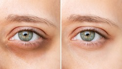 Cropped shot of young caucasian woman's face with dark circles under eyes before and after cosmetic treatment on a white bqckground. Bruises under eyes. Result of using concealer