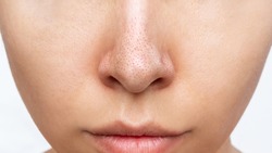 Close-up of woman's nose with black heads or black dots isolated on a white background. Acne problem, comedones. Enlarged pores on the face. Blackheads on greasy skin